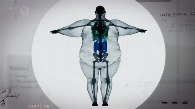 Keith Martin: The X-Ray That Sparked a Global Conversation on Weight Loss and Modern Treatment Options